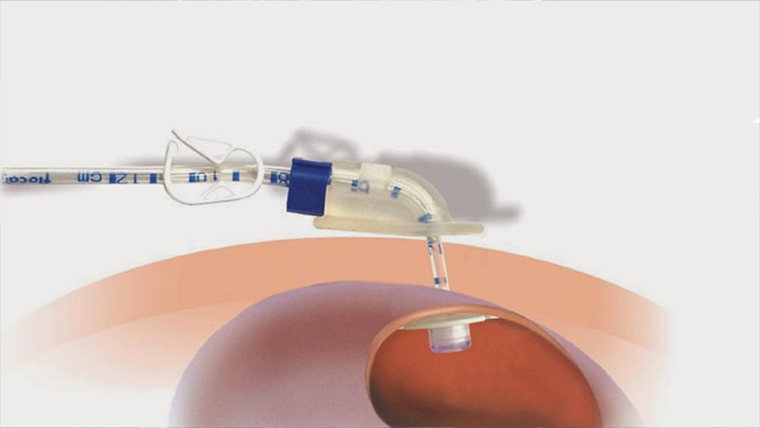 Perkütan Endoskopik Gastrostomi